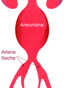 Aneurisma Aorta Addominale